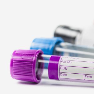 SARS-CoV2 Antibody testing